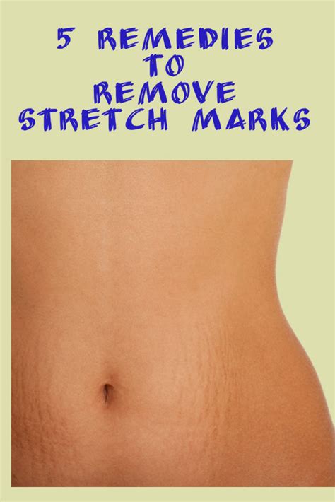 5 remedies to remove Stretch Marks