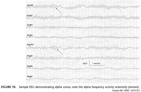 Eeg Test Results