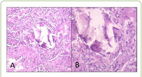 Aggravated chronic inflammation with foreign body granulomatous ...