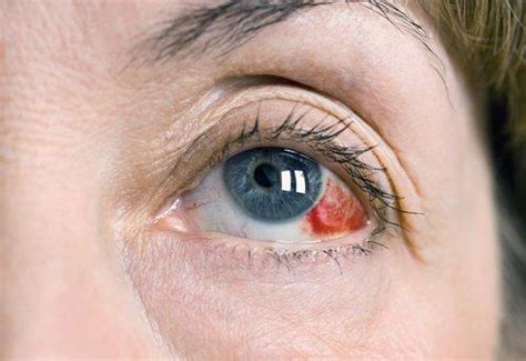 Athens, GA Subconjunctive Hemorrhage - Reddy Medical Group