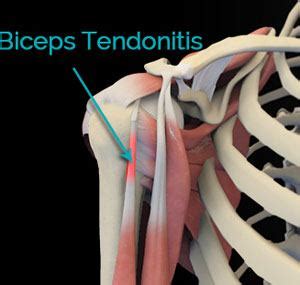 Biceps Tendonitis Cincinnati | Shoulder Pain Treatment West Chester ...