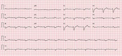 ECG showing sinus rhythm, heart rate 67 bpm, first-degree... | Download ...