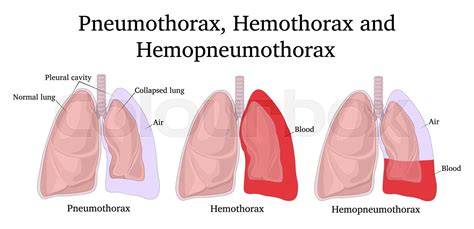 neumotórax, hemotórax, pleural | Vector de archivo | Colourbox
