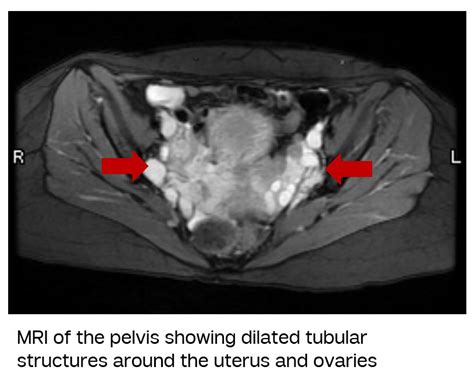 Pelvic Congestion Syndrome | Vein Treatment Center