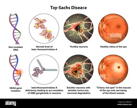 Inherited retinal disease Cut Out Stock Images & Pictures - Alamy