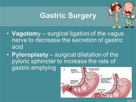 Vagotomy And Pyloroplasty