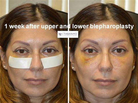 Upper Blepharoplasty Beverly Hills | Eyelid Lift Los Angeles