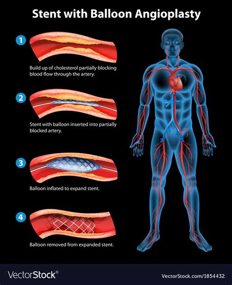 Stent angioplasty procedure Royalty Free Vector Image