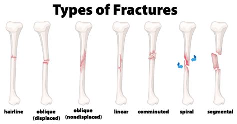 Signs, Symptoms, and Treatment of Fractures - Lompoc Valley Medical Center