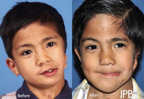 Craniofacial Surgery Before & After Photos | James P. Bradley, MD