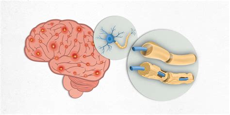 Esclerosis Múltiple - - Ms, en sus iniciales castellanas e inglesas) es una enfermedad ...