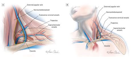 The Supraclavicular Artery Island Flap in Head and Neck Reconstruction ...