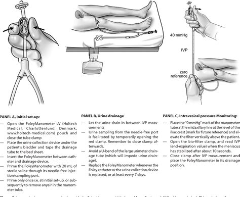 [PDF] A user's guide to intra-abdominal pressure measurement. | Semantic Scholar