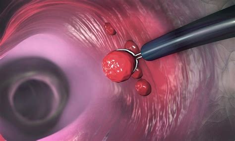 Cary Gastroenterology Associates | What Are Fundic Gland Polyps?