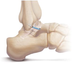 Ankle Arthroscopy and Ankle Ligament Reconstruction | Murdoch Orthopaedic Clinic