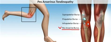 무릎 내측 통증 [거위발 건염, Pes Anserine Bursitis] : 네이버 블로그