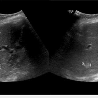 The ultrasonography of the liver showed a 1.6 cm hepatic lesion. | Download Scientific Diagram