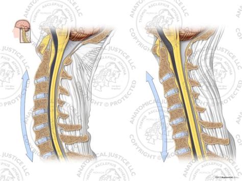 Normal vs. Reversal of Cervical Lordosis | Medical Illustrations