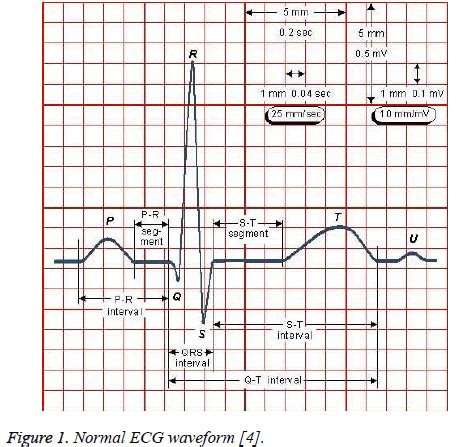 ECG signal classification and parameter | Biomedical Research