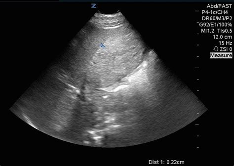 Hennepin Ultrasound | What’s causing his RUQ pain?