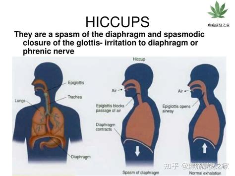 中西医治疗呃逆（打嗝）方法对比 - 知乎