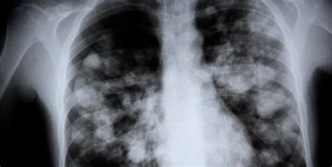 What Is White Lung Syndrome? Signs, Symptoms, and Treatment Options