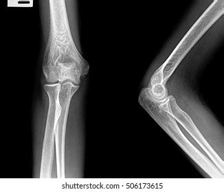 X-ray View Elbow Stock Photo 506173615 | Shutterstock