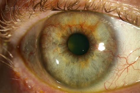 Atlas Entry - Rubeosis iridis or neovascularization of the iris in diabetes