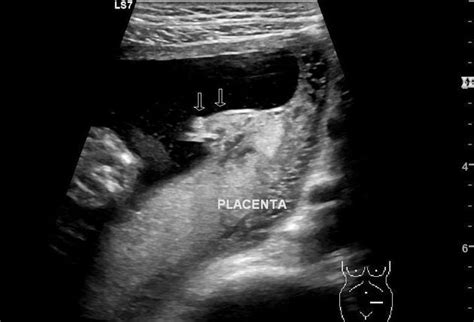 Circumvallate placenta | Radiology Case | Radiopaedia.org | Ultrasound ...