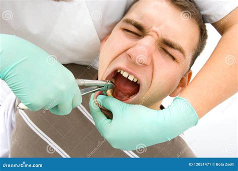 Dental extraction stock image. Image of mouth, diagnosis - 12051471