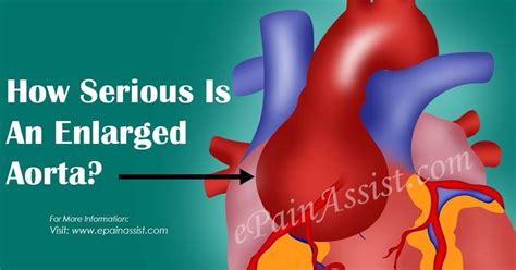 Daily Juggling Act: Enlarged Aorta