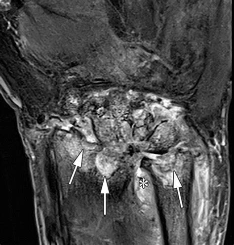 De Quervains Tendonitis Mri