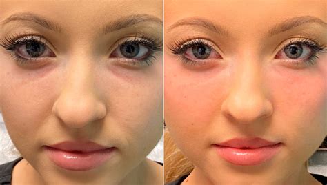 Injections, Tear Trough / Under Eye Injections photos | Chevy Chase, MD ...