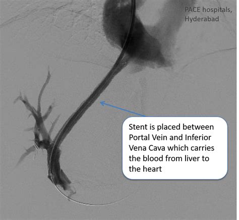 Budd-Chiari syndrome (Hepatic Vein Thrombosis) - DIPS procedure