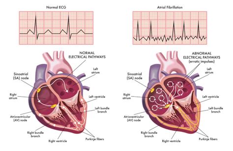 Difference between Atrial Fibrillation and Atrial Flutter | Pulse ...