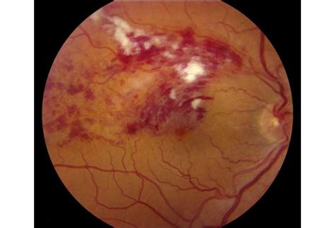 BRVO, Branch Retinal Vein Occlusion, BRVO Eye, BRVO Treatment