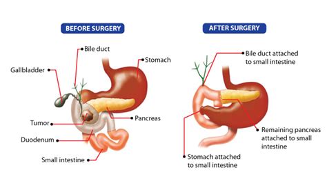 Whipple Surgery offers hope and potential cure for pancreatic cancer ...