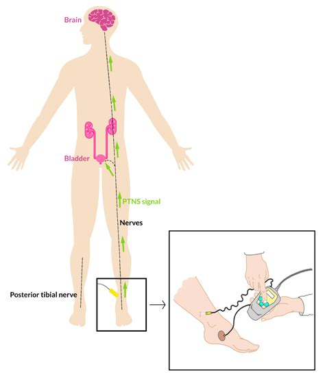 IJERPH | Free Full-Text | Posterior Tibial Nerve Stimulation in ...