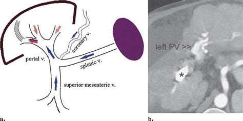 TIPS in a patient with cirrhosis. (a) Diagram shows hepatofugal flow in ...