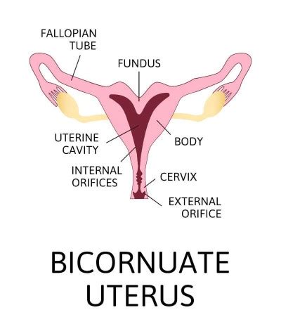 What is uterus bicornis (Bicornuate uterus)? - Bedaya hospital