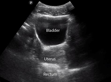 #POCUS is the FASTEST way to assess your patient's Bladder! 1⃣Learn How to Perform Bladder ...