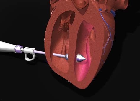 Light-Reflecting Balloon Catheter for Heart Repair