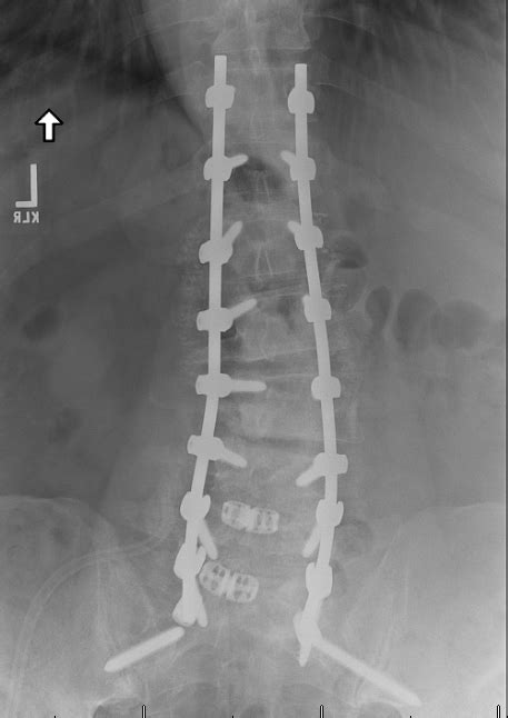 Pedicle Subtraction Osteotomy | Houston Scoliosis & Spine Institute