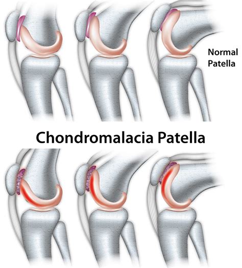 Chondromalacia patella - Pictures