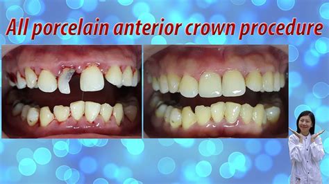 All porcelain anterior crown procedure - YouTube