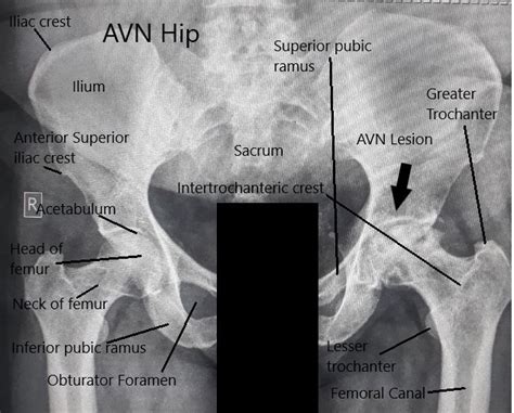 Alcohol Intake & Avascular Necrosis of The Hip | Complete Orthopedics