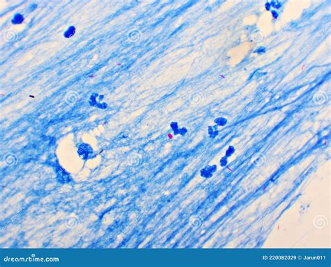 Sputum Smear Under Microscopy Showing Gram Positive Cocci Bacteria ...