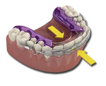 How does Inman Aligner work - Inman Aligner