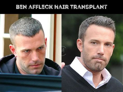 Ben Affleck Hair Transplant - Hair Loss & Technical Analysis