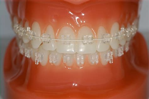 Types Of Orthodontic Braces